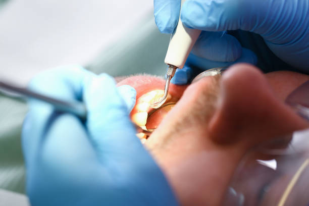 Best Emergency Root Canal Treatment in East Hemet, CA