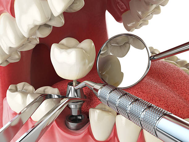 Best Emergency Wisdom Teeth Removal in East Hemet, CA
